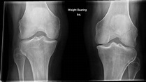 Knee (Rosenberg view) | Radiology Reference Article | Radiopaedia.org