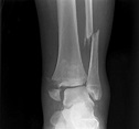 Fracture Treatment, Diagnosis and More | Rockwall Orthopedic Surgeon
