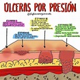 CLASIFICACIÓN DE ÚLCERAS POR PRESIÓN (escaras).⚠️⚠️ . . #enfermeria # ...