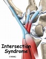 Intersection Syndrome - James Seeds, MD, Orthopedic & Sports Medicine ...