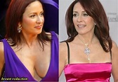 Patricia Heaton Plastic Surgery Before and After – Celebrity Plastic ...