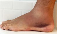 What I Learned Treating my Own Ankle Sprain