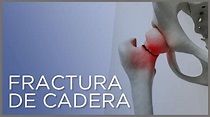 Fractura de cadera: causas, síntomas y tratamiento - YouTube