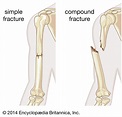 Simple fracture | pathology | Britannica
