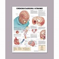 Anatomical Chart for Understanding Stroke :: Sports Supports | Mobility ...