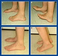 Foot and Ankle Deformities | Musculoskeletal Key