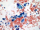 Urinary Cytopathology – Cellnetpathology.com
