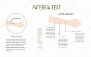 Infografía que explica la prueba de Patergia para detectar la ...