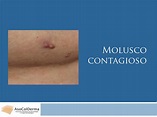 Qué es el molusco contagioso? by Asociacion Colombiana de Dermatologia ...