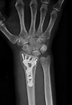 Distal Radius Fracture - Raleigh Hand Surgery — Joseph J. Schreiber, MD