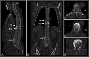 Whole-spine Computed Tomography Findings in SAPHO Syndrome | The ...