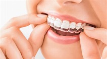 ¿Cómo funciona la ortodoncia con alineadores invisibles? – Estudi ...