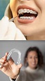 箍牙價錢2024！透明牙箍、傳統箍牙分別！Zenyum、Beame、隱適美透明牙箍價錢、療程比較！ | ELLE HK
