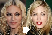 Madonna Plastic Surgery - An Amazing Look