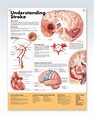 Understanding Stroke Exam-Room Anatomy Poster – ClinicalPosters