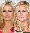 Jennifer Coolidge Before and After Plastic Surgery Botox, Facial filler ...