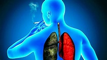 Cómo ha cambiado el paciente con cáncer de pulmón en España - AS.com