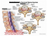 AMICUS Illustration of amicus,injury,cervical,spine,vertebra,C4,C5,C6 ...