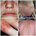malar rash | Defying Lupus