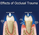 Occlusal trauma in dentistry | News | Dentagama