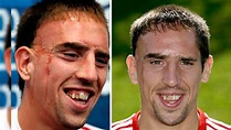 La verdadera historia detrás de la legendaria cicatriz de Frank Ribery ...