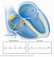 Atrial flutter - Symptoms and causes - Mayo Clinic