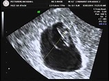 7 weeks 3 days ultrasound - YouTube