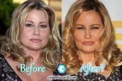 Jennifer Coolidge Plastic Surgery: Before After Facelift Pictures ...