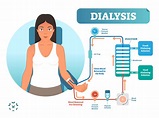 Dealing with Dialysis While Living with Lupus - Kaleidoscope Fighting Lupus