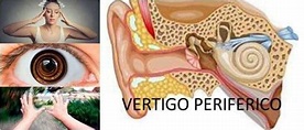 Vértigo Periférico: Síntomas Generales, Causas Comunes, Tipos ...