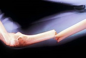 The Treatment of Closed Fractures