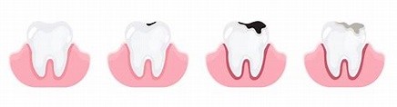 Vetores de Dentes Em Diferentes Estágios De Cárcie Cárie Dentária Dor ...