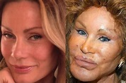 10 Celebs Who Ruined Their Faces Through Plastic Surgery | ewmoda