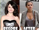 Selena Gomez Plastic Surgery Before and After Breast Implants and Lips ...