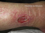 La compresión es clave en el tratamiento de las heridas en las piernas ...