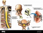 Spine Surgery - C4-C5 and C5-C6 Cervical Laminotomy and Foraminotomy ...