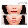 凹凸洞治療 — BEAUSKIN MEDICAL