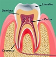 La pulpitis dental: causas y tratamiento