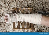 Woman with Her Broken Leg. Arm in a Cast. Stock Image - Image of broken ...