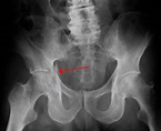 Acetabular fracture - Wikipedia