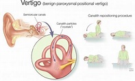 ¿Cuál es la causa del vértigo postural paroxístico benigno y existe ...