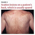 Scabies Causes Pictures Prevention And Treatment - vrogue.co