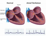 Atrial Fibrillation | The Heart & Diving - DAN Health & Diving