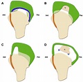 ( A–D ) Rotator cuff tear shapes. ( A ) Crescent-shaped tear. ( B ...