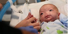 Junge hat seltenen Gendefekt: Baby Eli kam ohne Nase auf die Welt | Express