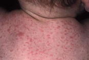 Roseola Rash - Pictures, Symptoms, Causes, Treatment, Home remedies