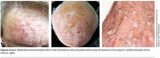 Actinic keratosis: an update on management | Medicine Today