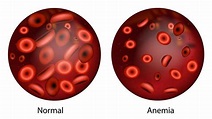 ¿Qué es la anemia? | Síntomas, causas y cómo tratar la enfermedad