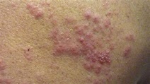 Síntomas del herpes zóster: causas y tratamiento de la enfermedad