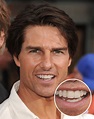 Tom Cruise's Middle Tooth — the Story Behind His Smile | Life & Style